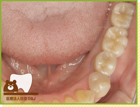 症例2 インプラント 3年経過の状態