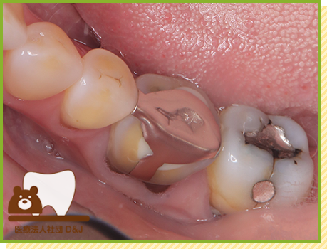 症例15 フルジルコニアクラウン 治療前の写真