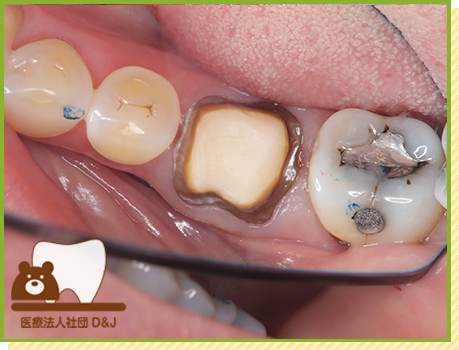 症例15 フルジルコニアクラウン 治療中の写真