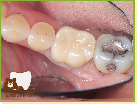 症例15 フルジルコニアクラウン 治療後の写真