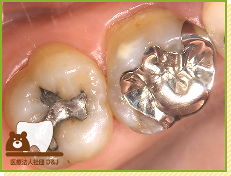 症例24 プレスセラミックインレー 治療前の写真