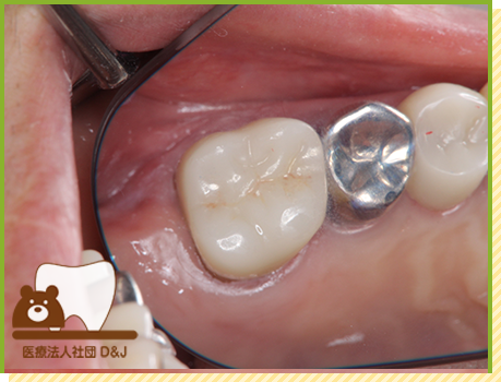 症例16 フルジルコニアクラウン 治療中の写真