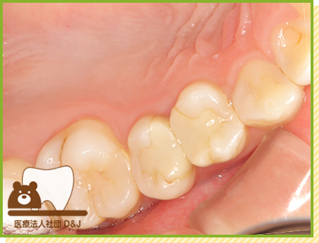 症例25 オールセラミックインレー 治療前の写真