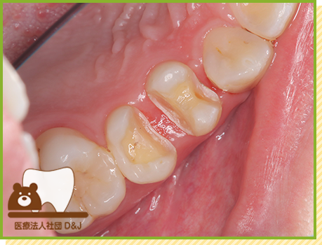 症例25 オールセラミックインレー 治療中の写真