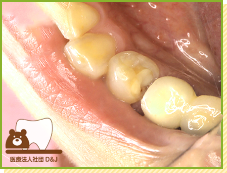 症例26 オールセラミックインレー 治療前の写真