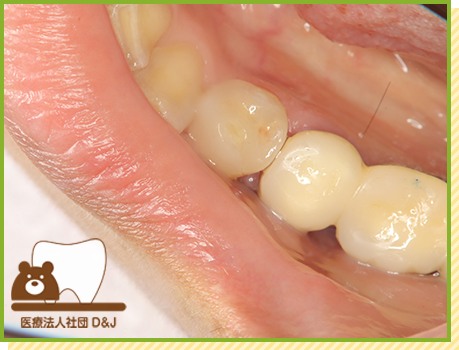 症例26 オールセラミックインレー 治療後の写真