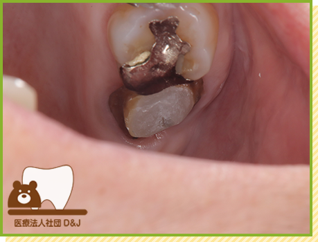 症例17 フルジルコニアクラウン 治療中の写真