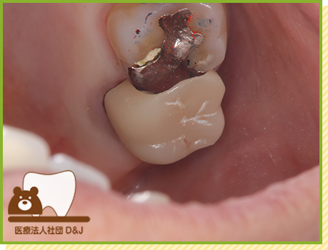 症例17 フルジルコニアクラウン 治療後の写真