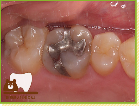 症例27 ゴールドインレー 治療前の写真