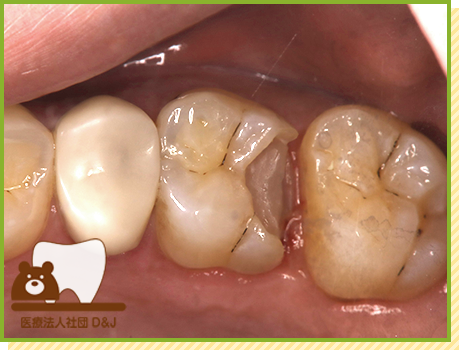 症例28 ハイブリットインレー 治療中の写真