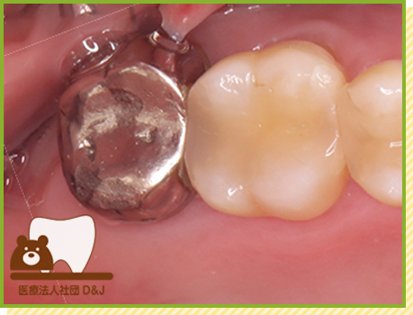 症例18 フルジルコニア・ファイバーコア 治療前の写真