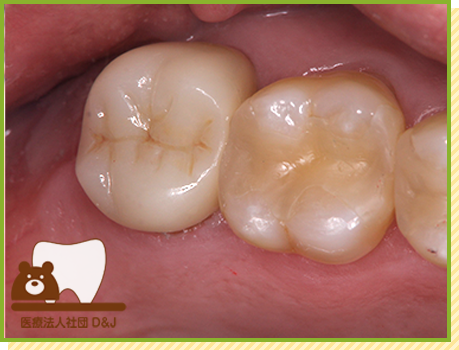症例18 フルジルコニア・ファイバーコア 治療後の写真