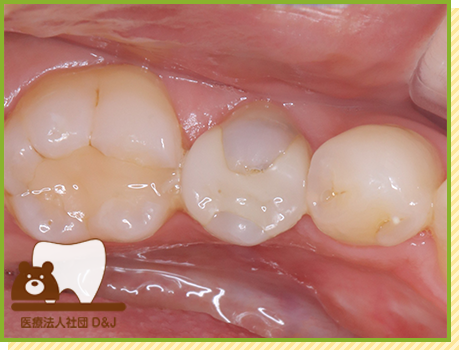 症例29 オールセラミックインレー 治療前の写真