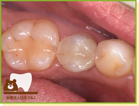 症例29 オールセラミックインレー 治療後の写真