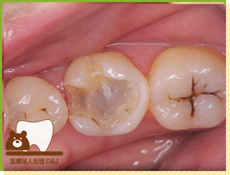 症例30 プレスセラミックインレー 治療中の写真