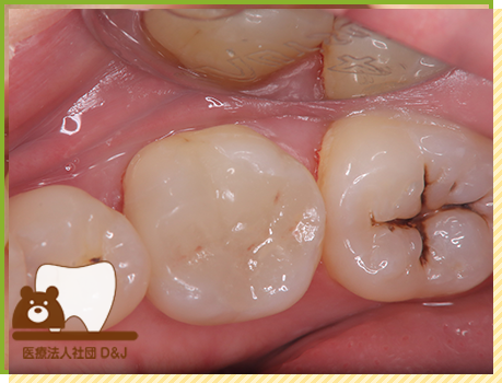 症例30 プレスセラミックインレー 治療後の写真