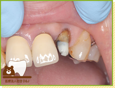 症例19 E-MAXクラウン 治療中の写真