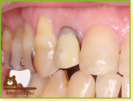 症例20 E-MAXクラウン 治療前の写真