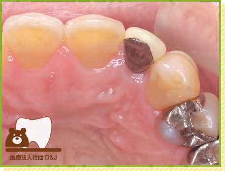 症例20 E-MAXクラウン 治療前の写真