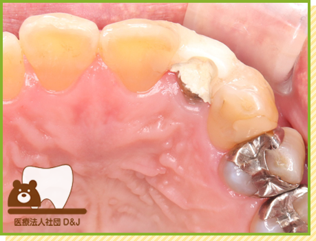 症例20 E-MAXクラウン 治療中の写真