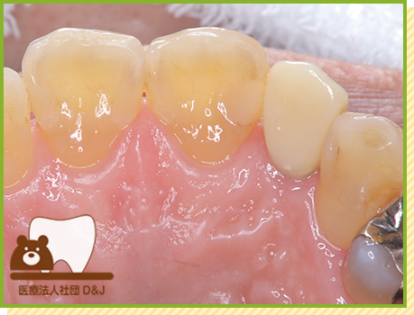 症例20 E-MAXクラウン 治療後の写真