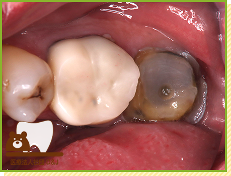 症例21 フルジルコニアクラウン 治療中の写真