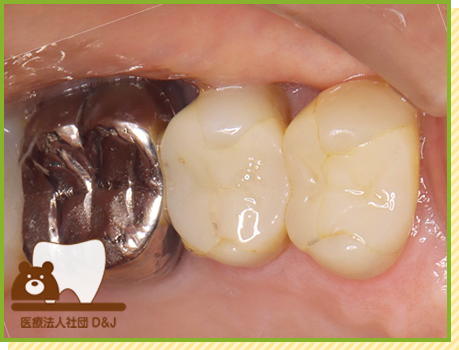 症例32 ハイブリットインレー 治療前の写真