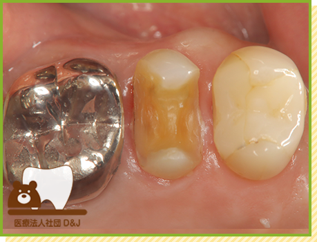 症例32 ハイブリットインレー 治療中の写真