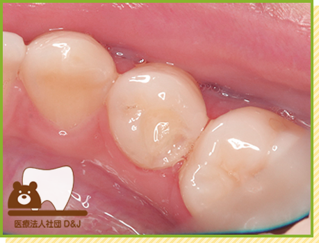 症例33 イーマックスインレー 治療後の写真