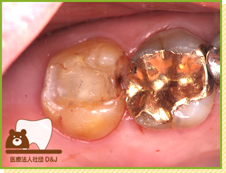 症例34 ゴールドインレー 治療中の写真