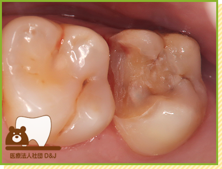 症例35 オールセラミックインレー 治療中の写真