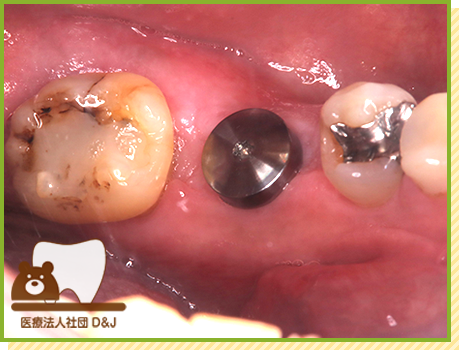 症例3 インプラント 埋入の写真