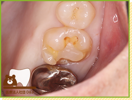 症例36 プレスセラミックインレー 治療中の写真