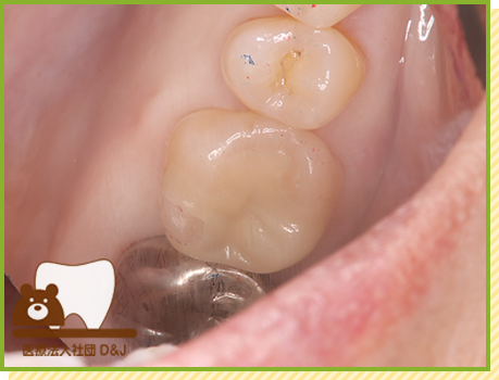 症例36 プレスセラミックインレー 治療後の写真